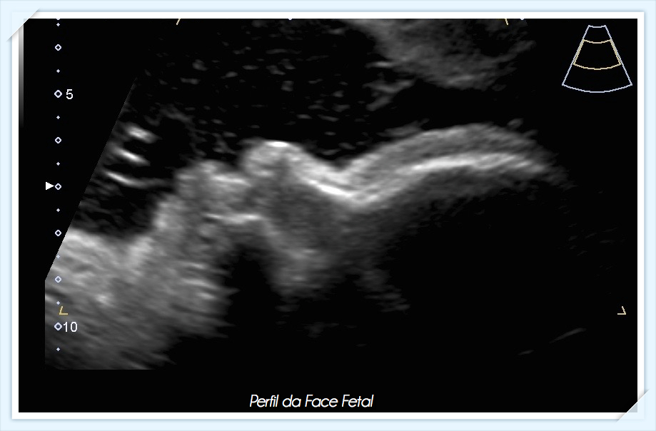 Perfil Fetal