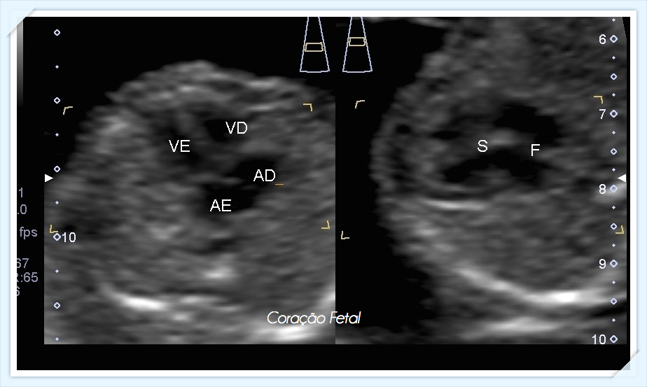 Coração Fetal