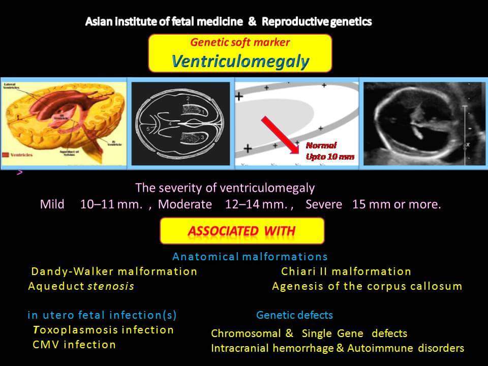 Ventriculomegaly