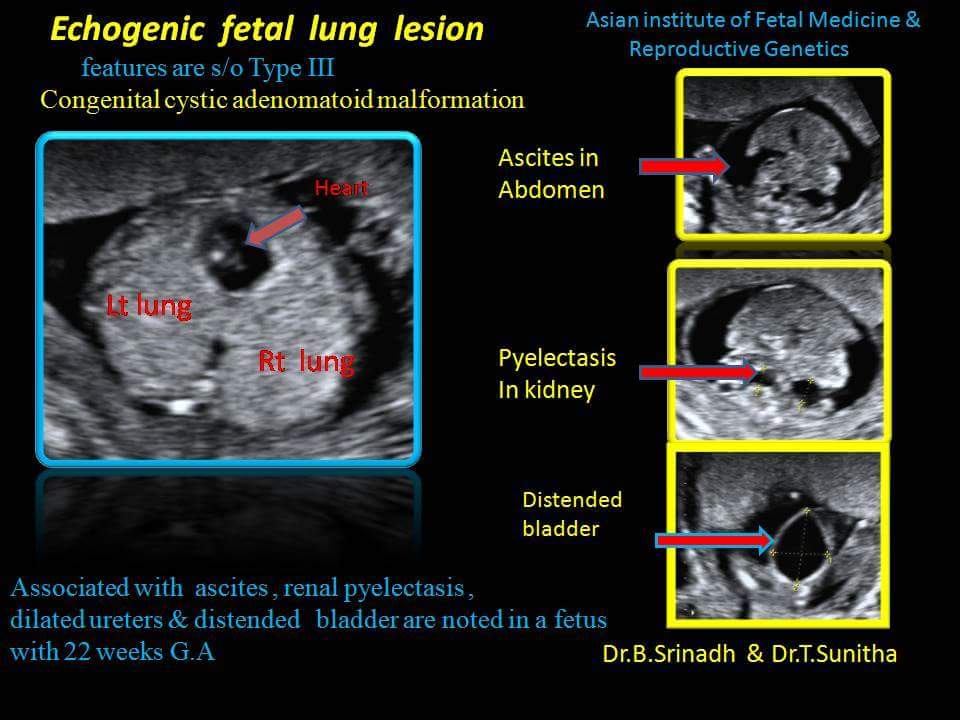 Echogenic Fetal Lung Lesion