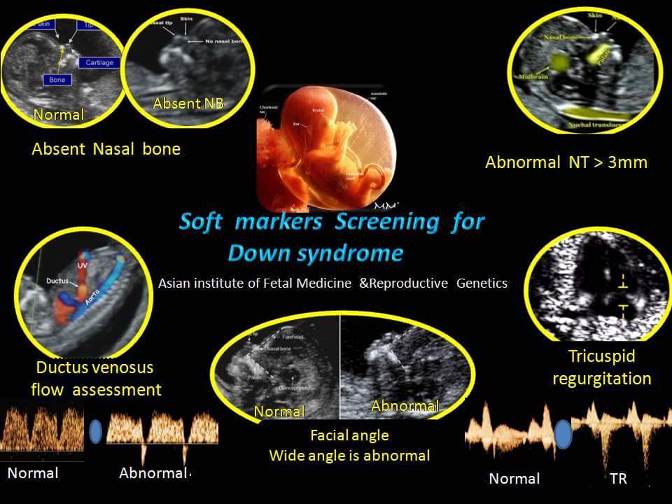 Soft Markers Screening for Down Syndrome