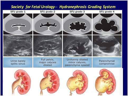 Hydronephrosis