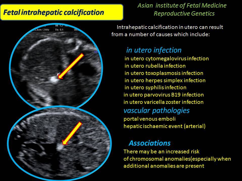 Calcificação Hepática Fetal