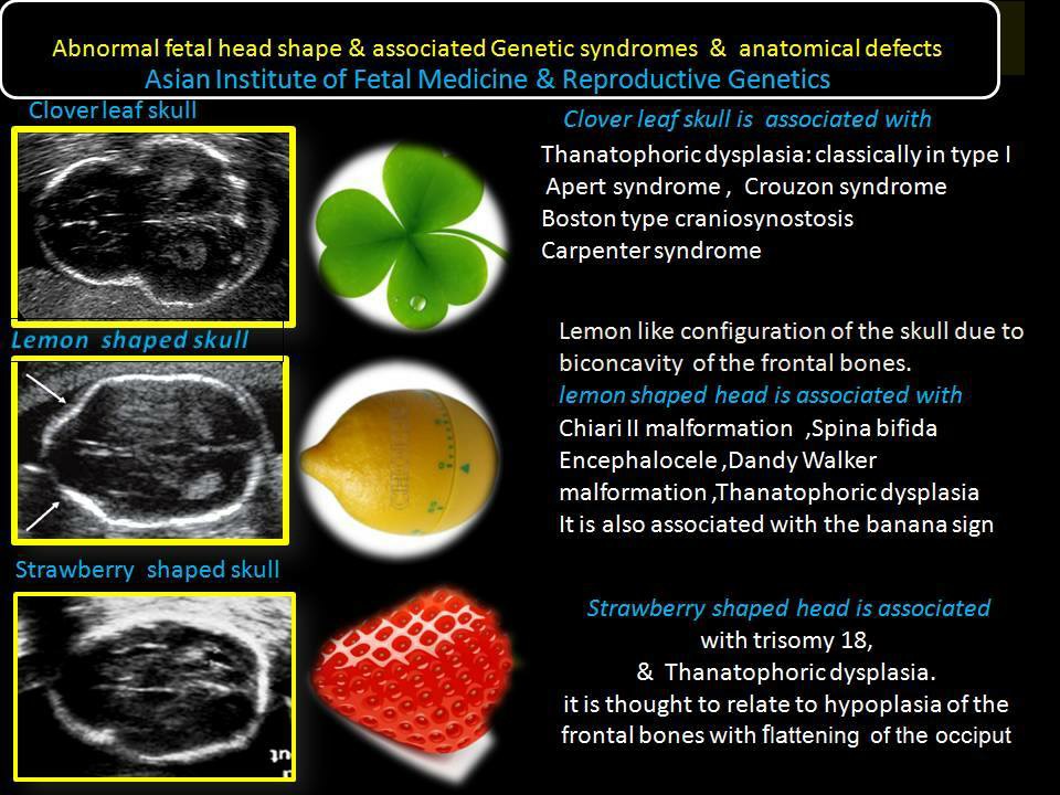 Abnormal Fetal Head Shape