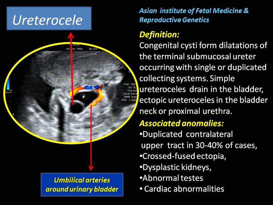 Ureterocele