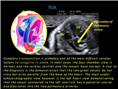 TGA