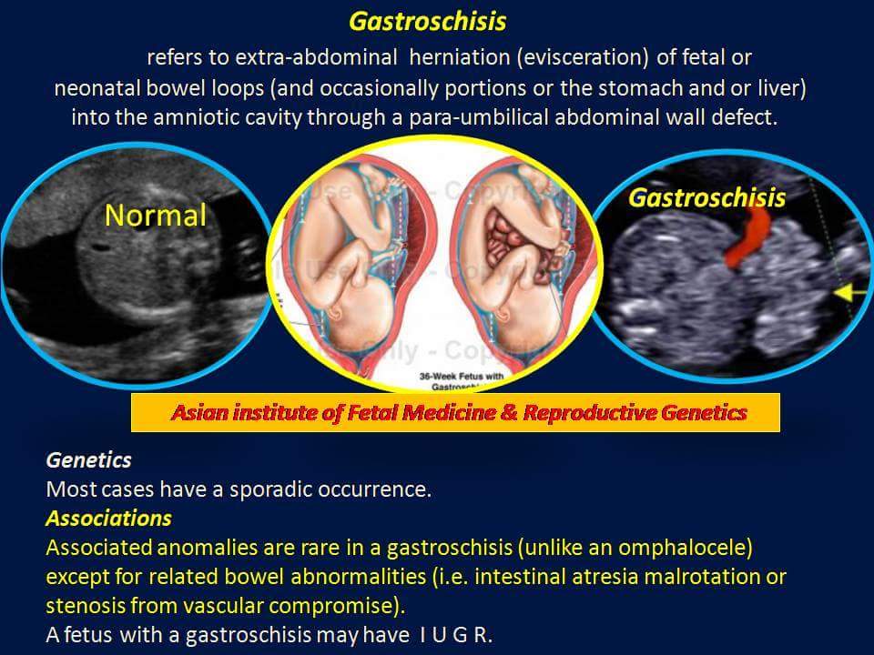 Gastroschisis