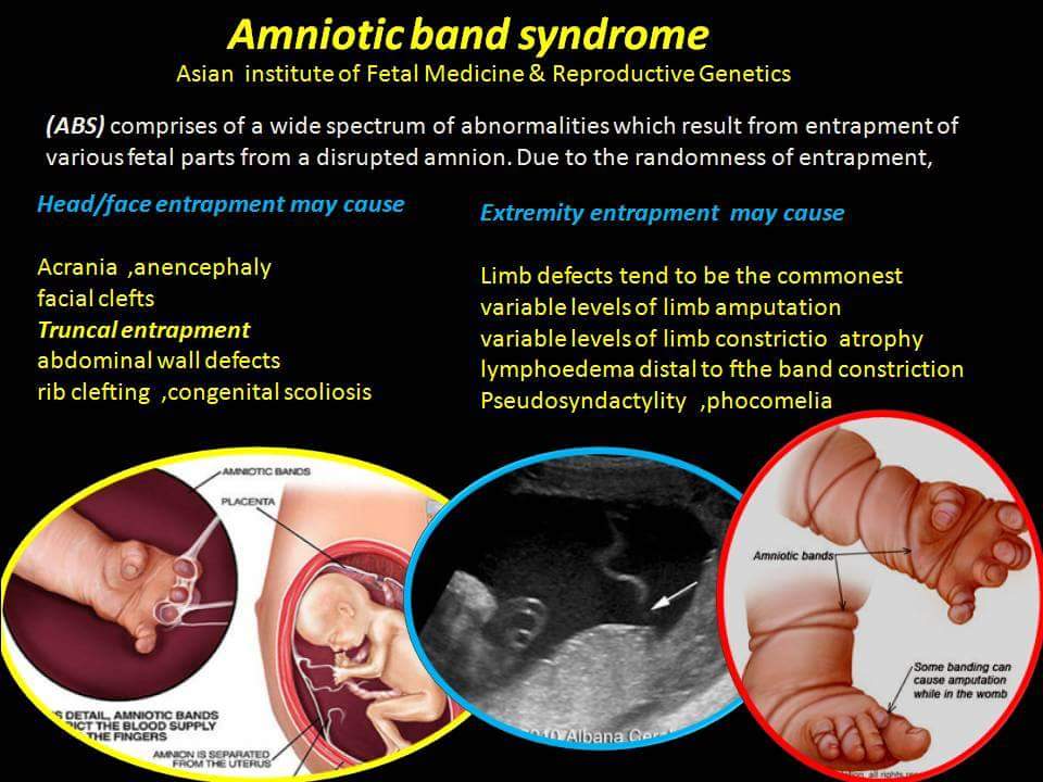 Amniotic Band Syndrome