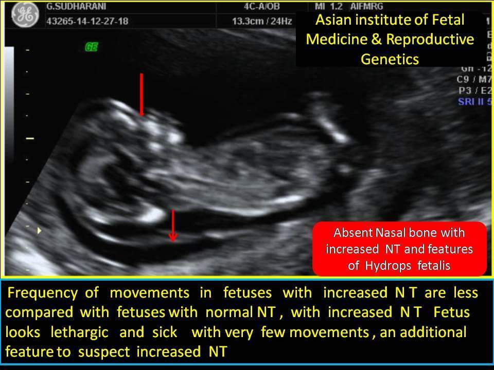 Absent Nasal Bone